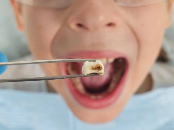 Best Emergency Root Canal Treatment in Iona, FL