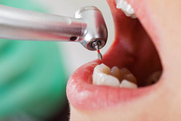 Best Emergency Tooth Extraction in Iona, FL
